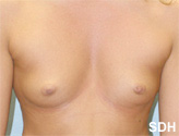 Patient # 13398 Before Photo # 1